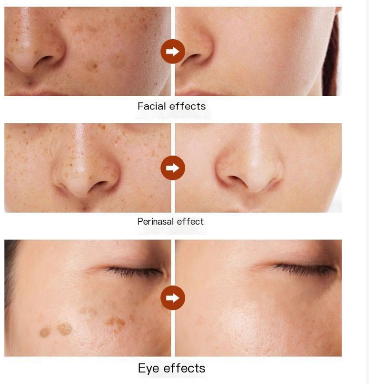 Miniatura: Herbal Astragalus Cream for Dark Spot Removal