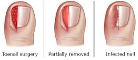 Ingrown Toenails - Central Texas Foot Specialist