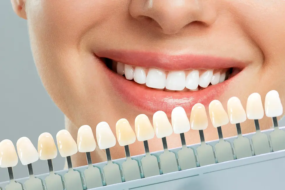 “Blanqueamiento dental en Puerto Montt | Clínica RODEN”