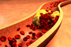 clogged-artery-with-platelets-and-cholesterol-plaque