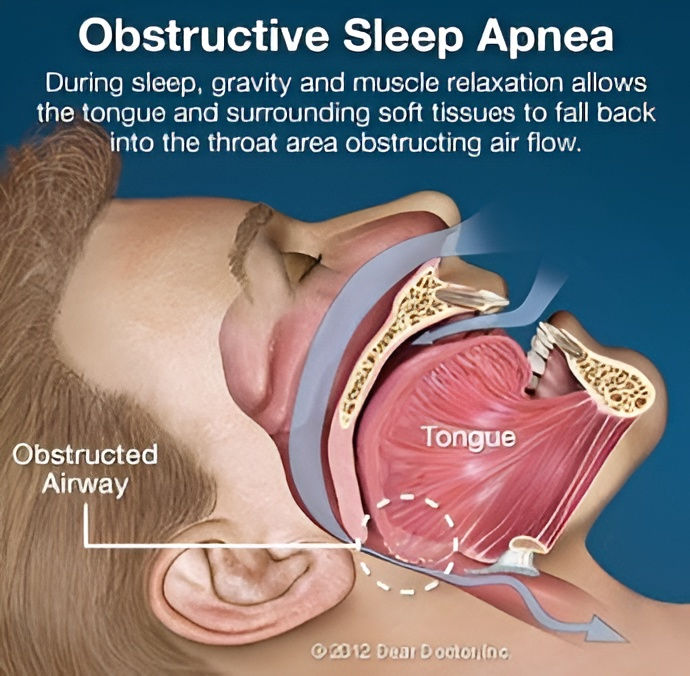 obstructive-sleep-apnea.jpg