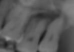Severe Periodontal Disease
