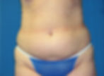 360417 Liposuction hip rolls, inner and outer thighs before06_edited