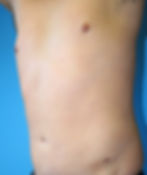 361973 Liposuction abdomen and flanks after0_edited