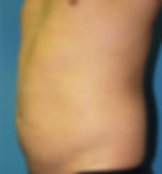 361973 Liposuction abdomen and flanks before3_edited
