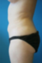 360417 Liposuction hip rolls, inner and outer thighs after5_edited