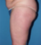 361375 liposuction thighs and flanks before08_edited