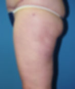 361375 liposuction thighs and flanks after08_edited