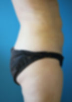 360417 Liposuction hip rolls, inner and outer thighs after3_edited