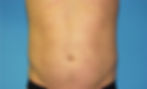 361973 Liposuction abdomen and flanks before4_edited