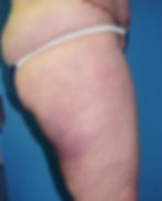 361375 liposuction thighs and flanks after04_edited