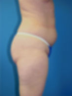 360417 Liposuction hip rolls, inner and outer thighs before00_edited