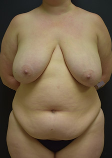 Seattle tummy tuck plastic surgery by board certified female plastic surgeon Dr. Megan Dreveskracht