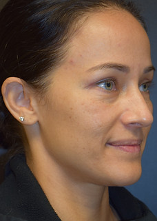 Seattle blepharoplasty eyelid surgery by board certified female plastic surgeon Dr. Megan Dreveskracht