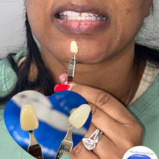 teeth whitening