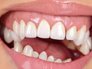 Close-up of a smiling mouth with shiny, white teeth and pink lips. The background is blurred, emphasizing the bright dental appearance.