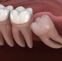 Wisdom Tooth Surgery