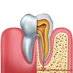 Root Canal Treatment