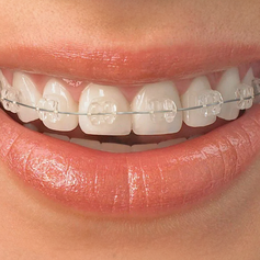 Braces