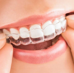 Invisalign