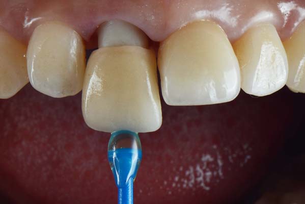 Dental crown model showing how a crown covers a tooth