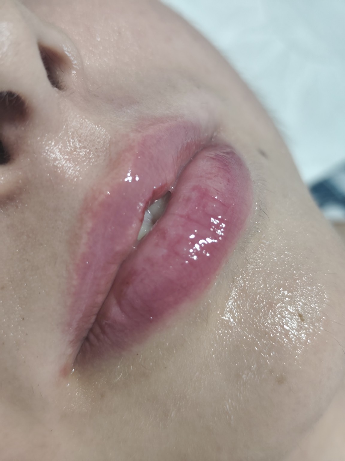 Hydra Lips VitalInk