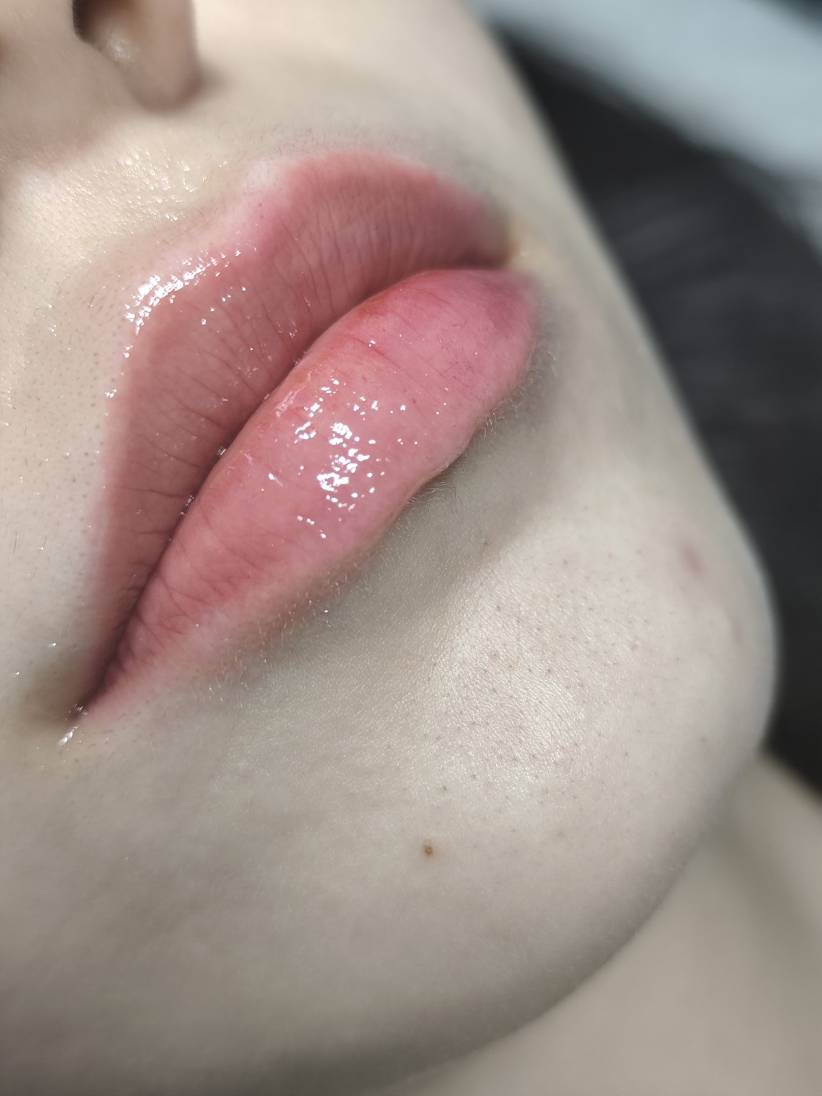 Hydra Lips tretman