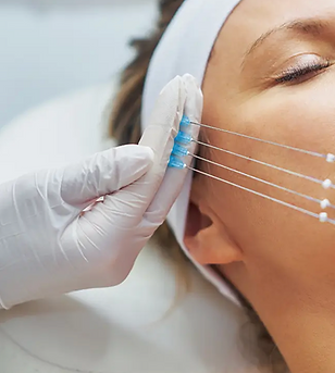 IMG 4 Hilos tensores.png