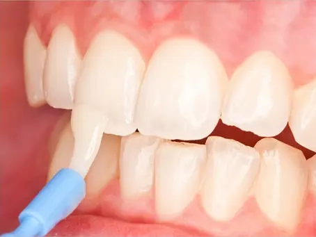 Understanding the Benefits of Topical Fluoride for Dental Health