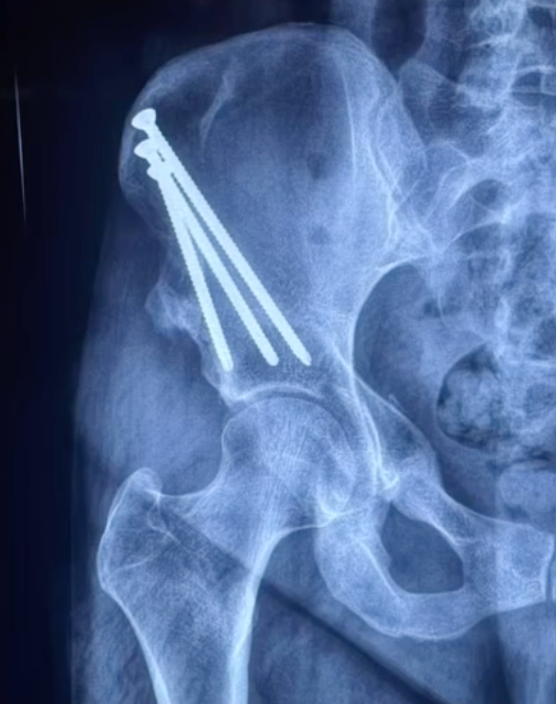 PAO - periacetabular osteotomy