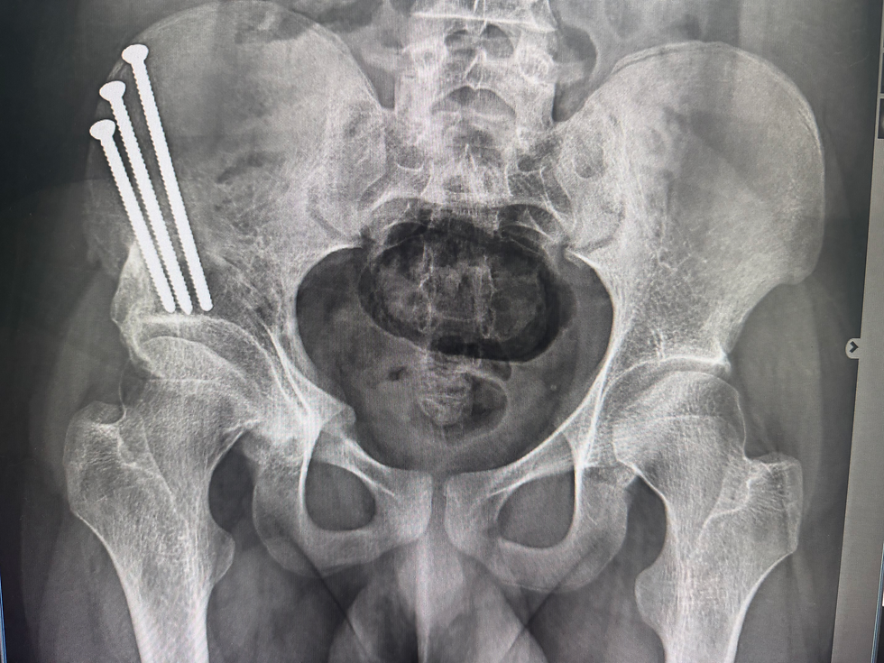 Hip Dysplasia in Adults: Signs, Symptoms, Diagnosis, and Treatment Options