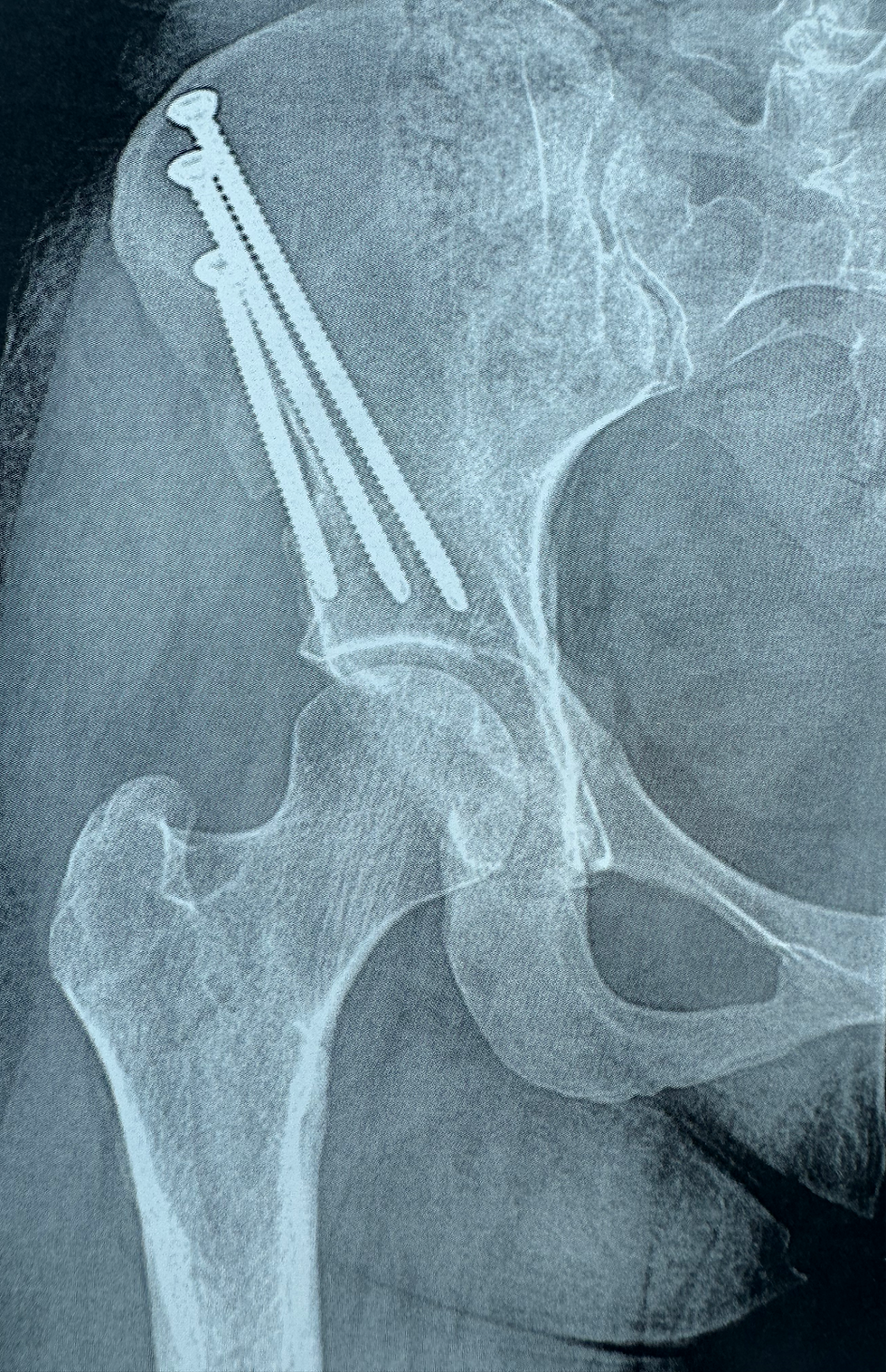 Osteotomia periacetabular Ganz