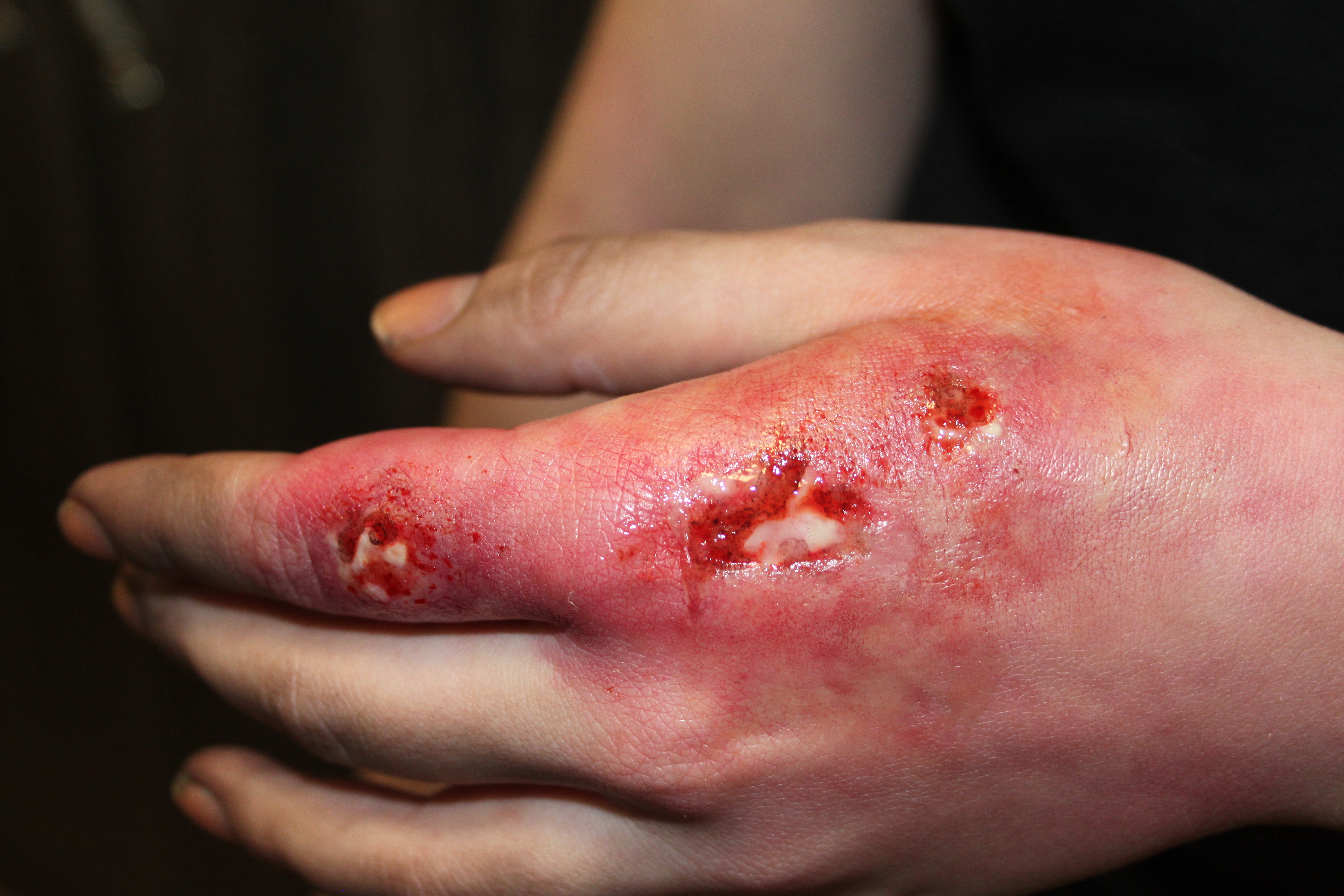 Infected hand sores