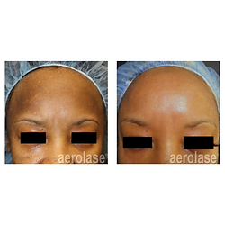 tropics beauty cafe aerolase melasma laser therapy
