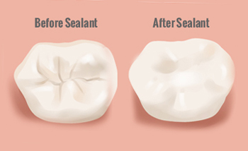 shiloh-dental-sealant.jpeg