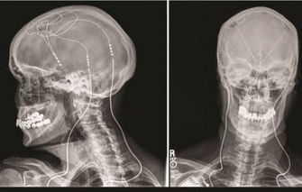 Watch How a 'Brain Pacemaker' Slows the Pace of Alzheimer's Disease