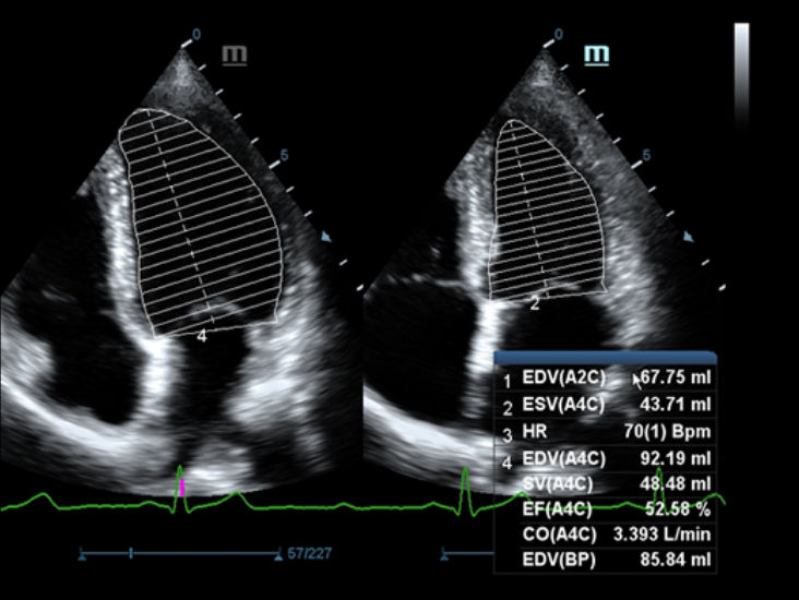 Thumbnail: DC60 - Cardiovascular Ultrasound System