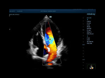 Thumbnail: DC80 - Cardiology Ultrasound