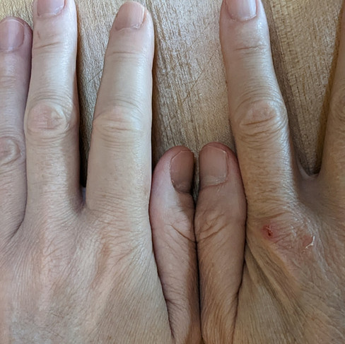 Dave's swollen finger