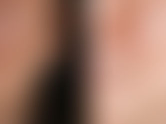 Understanding and Treating Hyperpigmentation: What You Need to Know