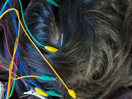 水頭症による眼の異常が改善