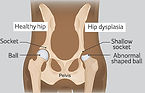 hip-dysplasia-small.jpg
