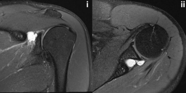 Posterior labral tear.png