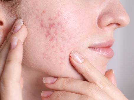 Acne skin