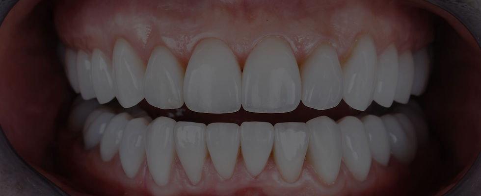 Same day crowns MPFD.jpg