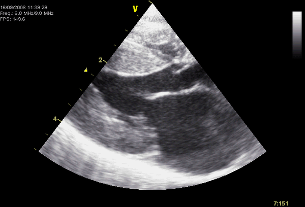 HCM-Echo.gif