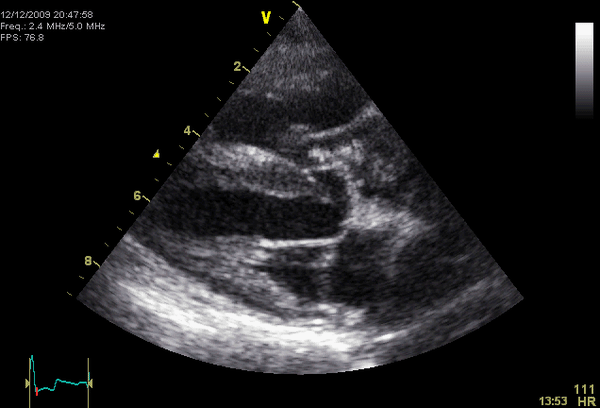 Caval-Syndrome-Echo.gif
