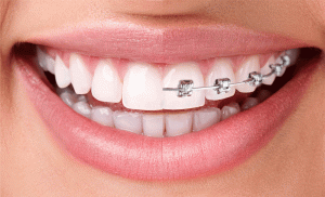 invisalign-dentist-global-family-dental-300x182-1.gif