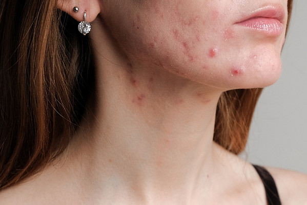 acne belmish prone skin treatment.png