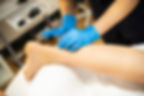 physiotherapist doing dry needling on patient